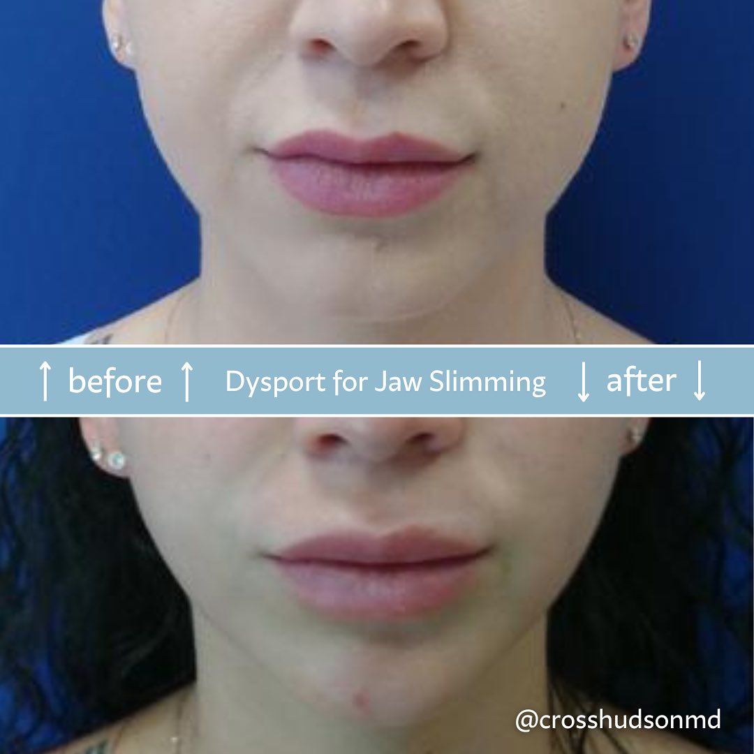Before and after Dysport for jaw slimming showing refined jawline contour